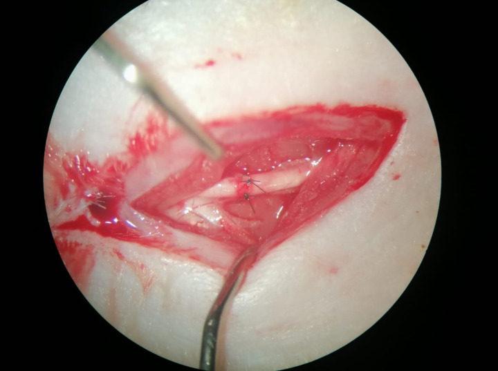 Clinical, electrophysiological, and histomorphological effects of local coenzyme Q10 and vitamin E use in a rat model of peripheral nerve injury.