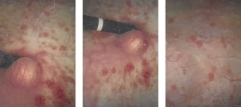 Foreign body granuloma development after calcium hydroxylapatite injection for stress urinary incontinence: A literature review and case report.