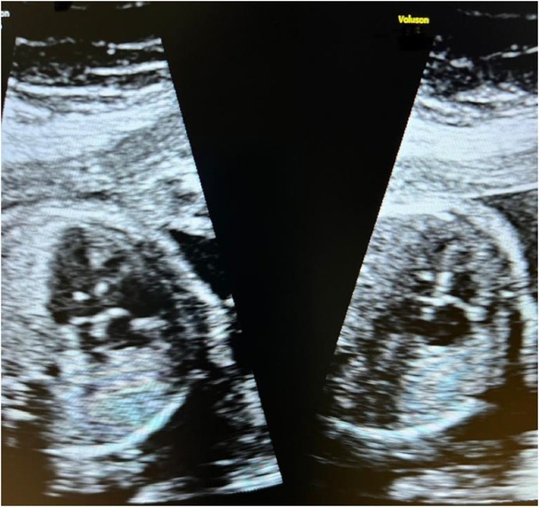 Radial Ray Anomaly with Associated Ventricular Septal Defect - Case Report with Review of Literature.