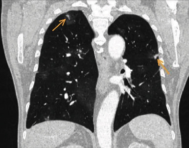 Diffuse Alveolar Hemorrhage Associated with Epithelioid Angiosarcoma of the Lung: A Challenging Diagnosis.