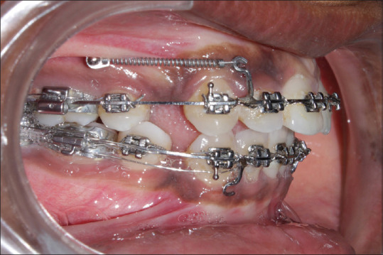 Effect of a Submucosal Injection of Platelet-Rich Plasma on the Rate of Orthodontic Tooth Movement - A Split-Mouth, Single-Blind Randomized Controlled Trial.