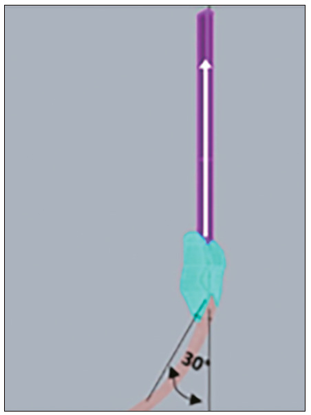 PATELLAR FRACTURE IN ANTERIOR CRUCIATE LIGAMENT RECONSTRUCTION: IN VITRO ANALYSIS.