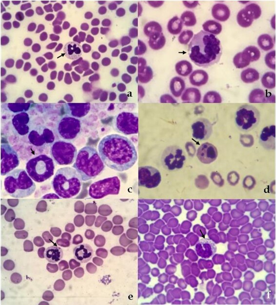 The importance of morphological changes in neutrophils in the diagnosis of bacterial infections in dogs with confirmed urinary tract infections in a Veterinary Care Service, Rio de Janeiro, Brazil.