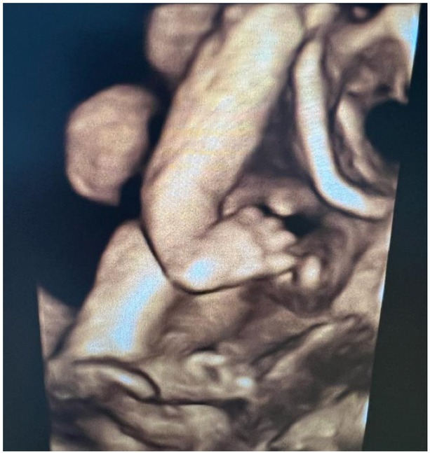 Radial Ray Anomaly with Associated Ventricular Septal Defect - Case Report with Review of Literature.