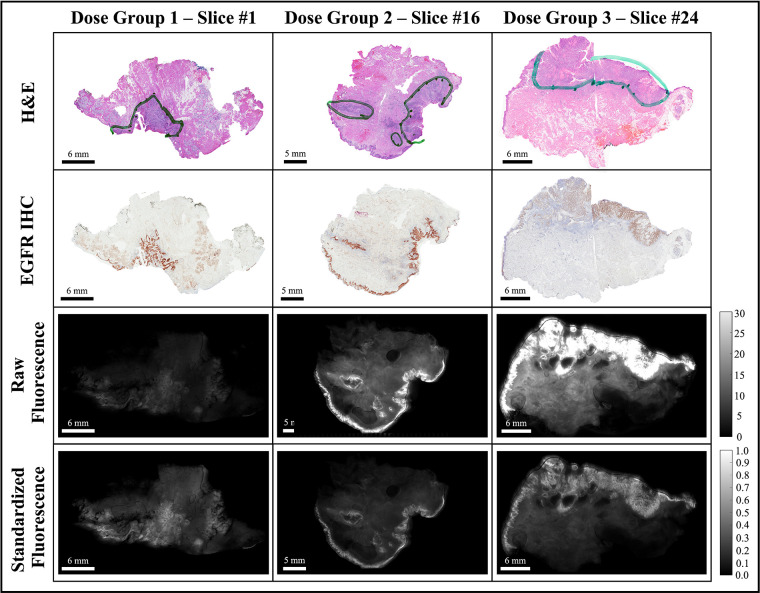 Fluorescence molecular optomic signatures improve identification of tumors in head and neck specimens.