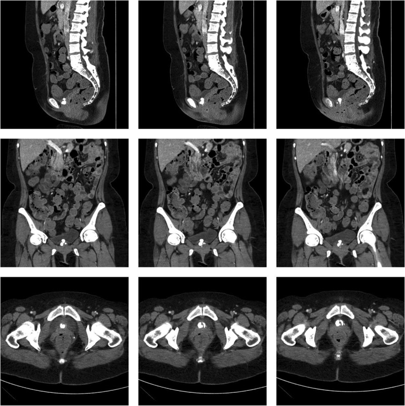 Foreign body granuloma development after calcium hydroxylapatite injection for stress urinary incontinence: A literature review and case report.