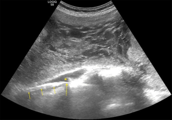 Ultrasound-guided prophylactic abdominal aortic balloon occlusion for placenta accreta spectrum disorder: A case series.