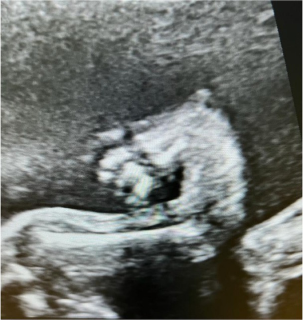 Radial Ray Anomaly with Associated Ventricular Septal Defect - Case Report with Review of Literature.