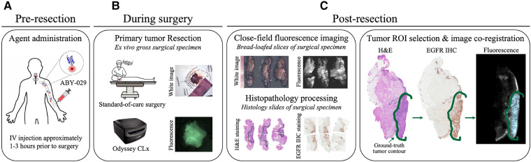 Fluorescence molecular optomic signatures improve identification of tumors in head and neck specimens.