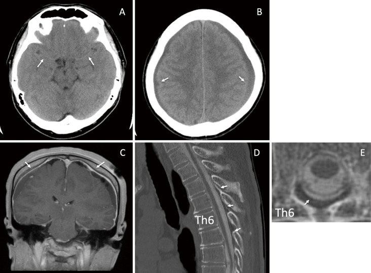 Two Cases of Chronic Subdural Hematoma with Spontaneous Intracranial Hypotention Treated with Hematoma Drainage Followed by Epidural Blood Patch Under Intracranial Pressure Monitoring.