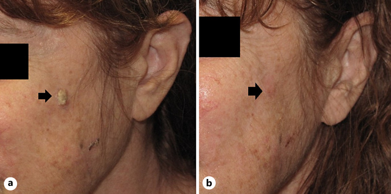 Use of Talimogene Laherparepvec to Treat Cutaneous Squamous Cell Carcinoma in a Renal Transplant Patient.