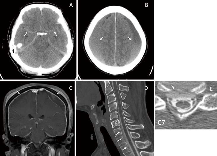 Two Cases of Chronic Subdural Hematoma with Spontaneous Intracranial Hypotention Treated with Hematoma Drainage Followed by Epidural Blood Patch Under Intracranial Pressure Monitoring.