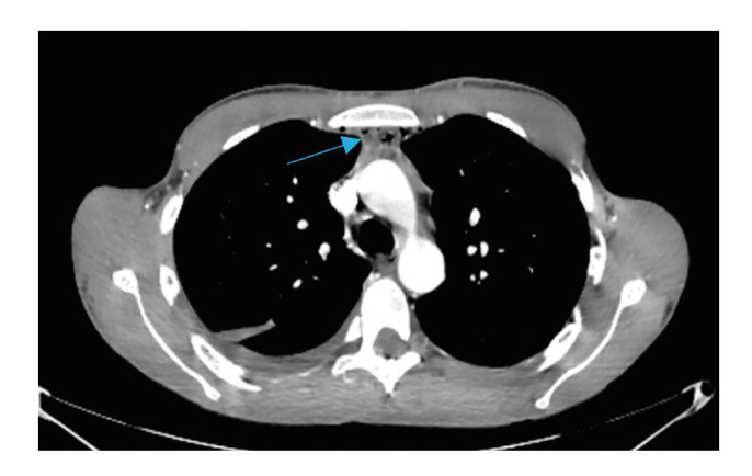 Survival rate of odontogenic descending necrotizing mediastinitis. Our experience in last 5 years.