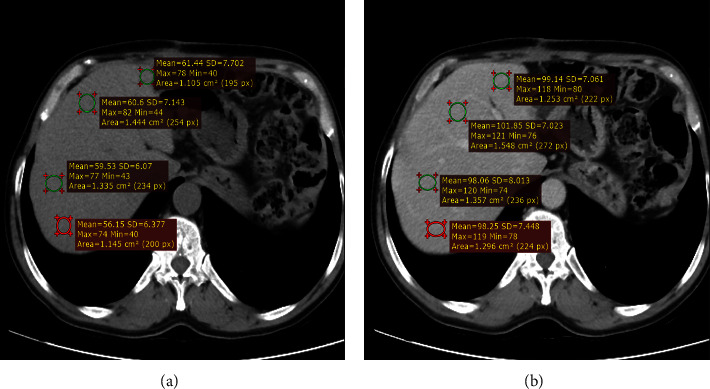 Evaluation of the Practice of Performing Abdominal CT Scan with Manually Administered Fixed Dose of Contrast in Achieving Adequate Hepatic Enhancement: An Institutional-Based Cross-Sectional Study.