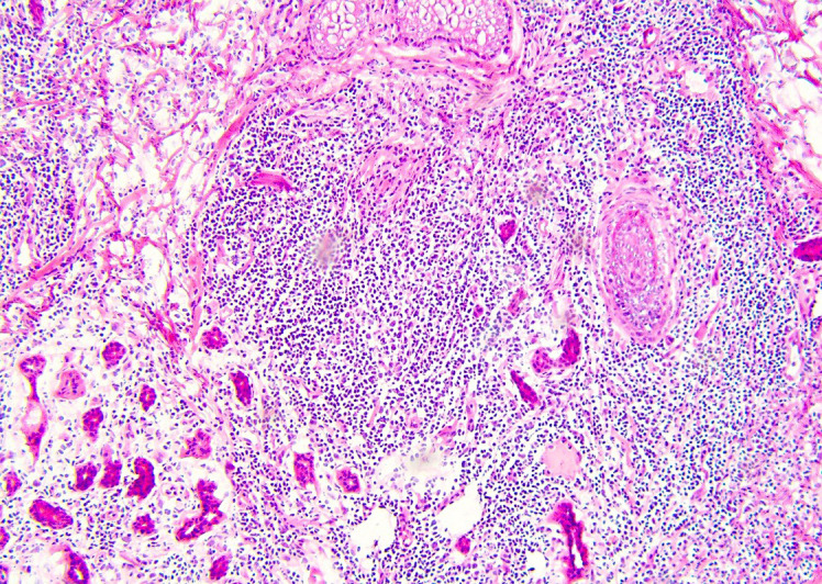 Use of Talimogene Laherparepvec to Treat Cutaneous Squamous Cell Carcinoma in a Renal Transplant Patient.