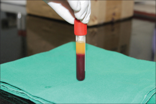 Effect of a Submucosal Injection of Platelet-Rich Plasma on the Rate of Orthodontic Tooth Movement - A Split-Mouth, Single-Blind Randomized Controlled Trial.