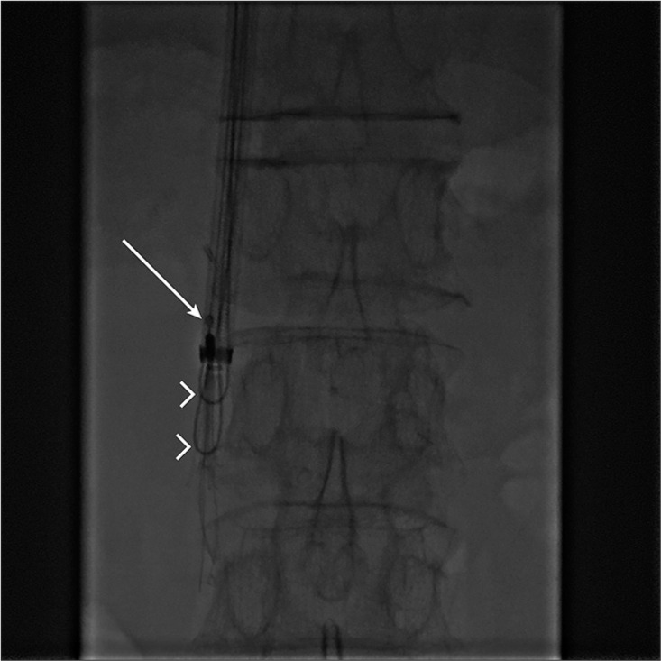 Management of failed inferior vena cava filter retrieval for complex cases: A case series.