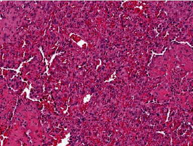 Diffuse Alveolar Hemorrhage Associated with Epithelioid Angiosarcoma of the Lung: A Challenging Diagnosis.