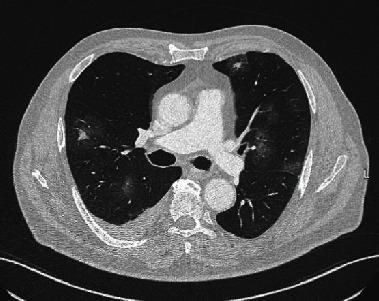 Diffuse Alveolar Hemorrhage Associated with Epithelioid Angiosarcoma of the Lung: A Challenging Diagnosis.