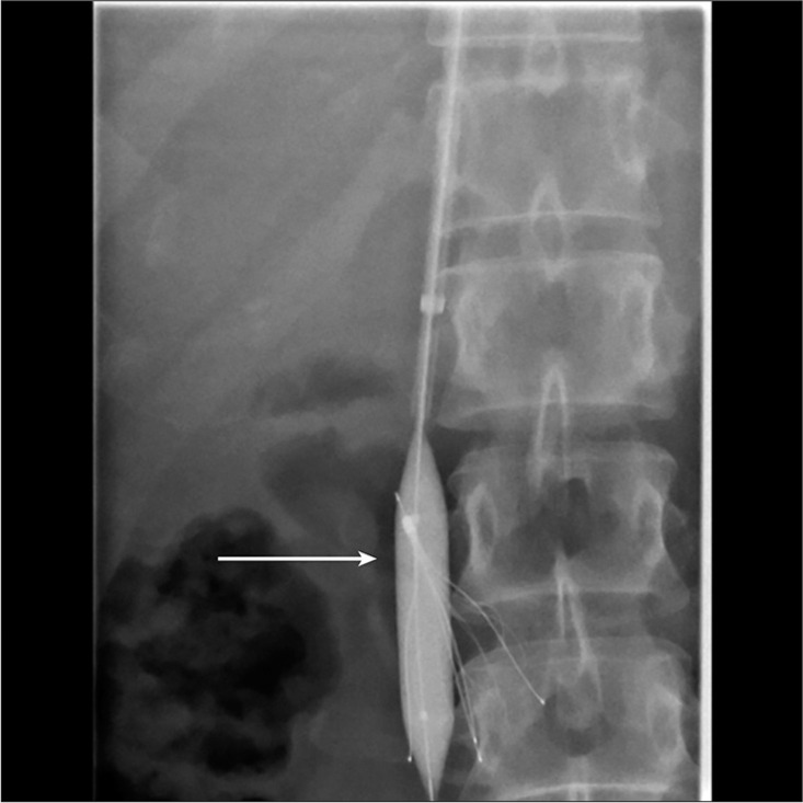 Management of failed inferior vena cava filter retrieval for complex cases: A case series.