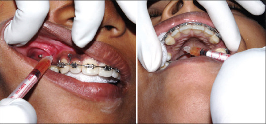 Effect of a Submucosal Injection of Platelet-Rich Plasma on the Rate of Orthodontic Tooth Movement - A Split-Mouth, Single-Blind Randomized Controlled Trial.