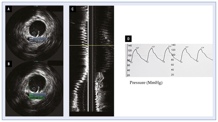 Intravascular ultrasound imaging in evaluation of aortic stiffness: A proof-of-concept study.