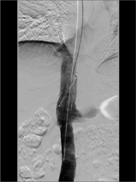 Management of failed inferior vena cava filter retrieval for complex cases: A case series.