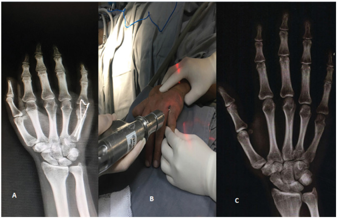 METACARPAL FRACTURES TREATMENT: COMPARASION BETWEEN KIRSCHNER WIRE AND INTRAMEDULLARY SCREW.