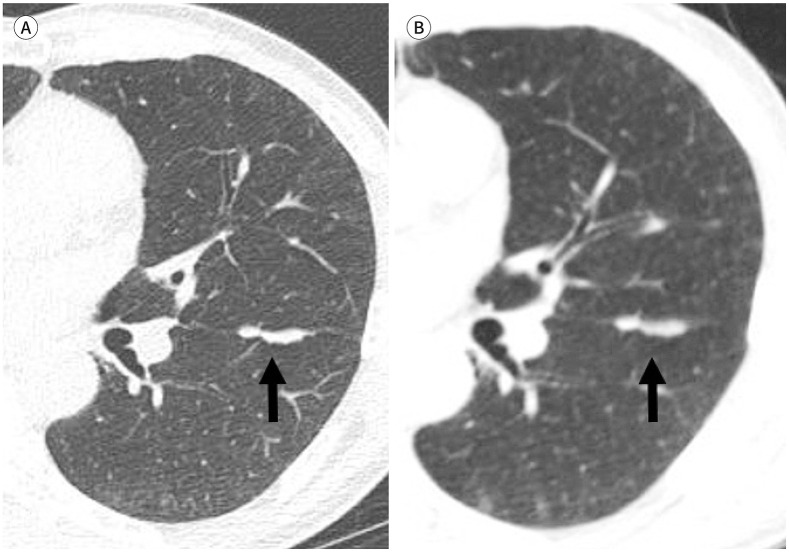 [Lung Imaging Reporting and Data System (Lung-RADS) in Radiology: Strengths, Weaknesses and Improvement].