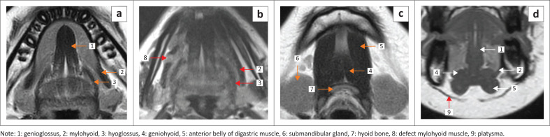 Imaging evaluation of the benign and malignant lesions of the floor of the mouth: Pictorial review.