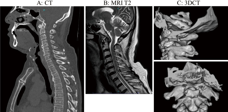 Speech-language Pathology Rehabilitation in a Case of Jefferson Fracture Complicated with Lower Cranial Nerve Palsies.