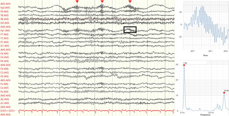 EEG-Delta brushes in DPPX encephalitis – Welcome to the club