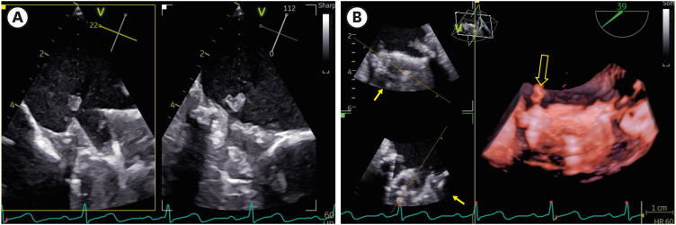 Persistent Fever in a Patient With Mechanical Mitral Valve Replacement.