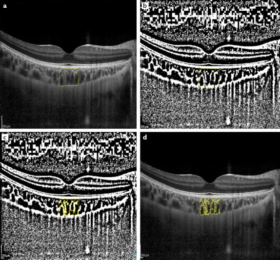 Evaluation of Choroidal Vascular Structure in Hyperopic Anisometropic Amblyopia.