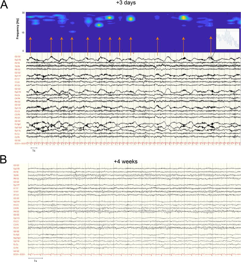 EEG-Delta brushes in DPPX encephalitis – Welcome to the club