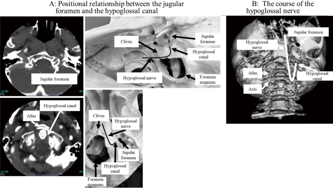 Speech-language Pathology Rehabilitation in a Case of Jefferson Fracture Complicated with Lower Cranial Nerve Palsies.