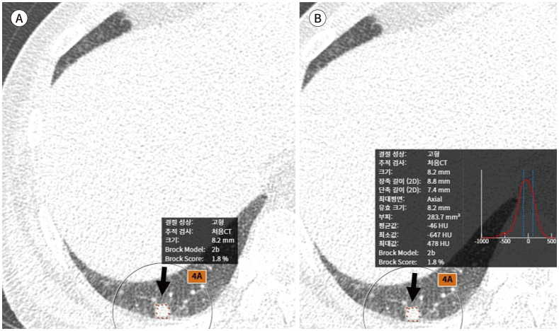 [Lung Imaging Reporting and Data System (Lung-RADS) in Radiology: Strengths, Weaknesses and Improvement].