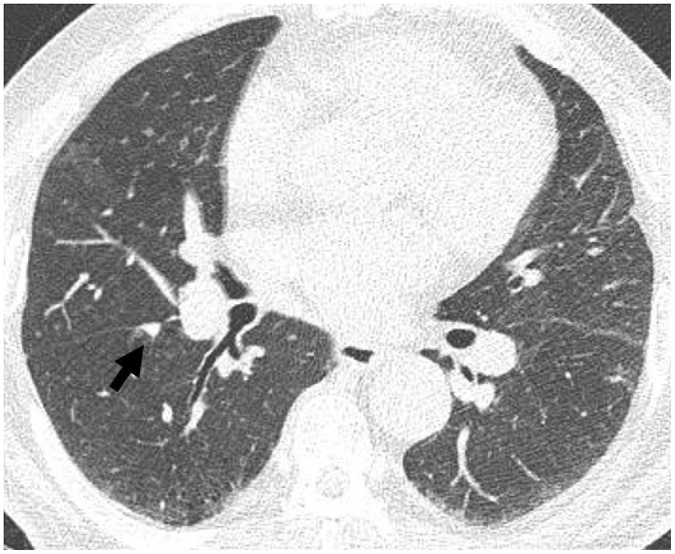 [Lung Imaging Reporting and Data System (Lung-RADS) in Radiology: Strengths, Weaknesses and Improvement].