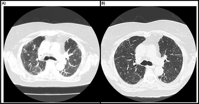 Post COVID Interstitial Lung Abnormalities-Incidence and Management.