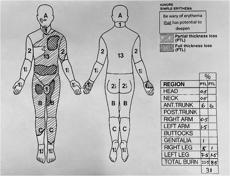 To bleed or not to bleed? Case series and discussion of haemorrhage risk with enzymatic debridement in burn injuries.