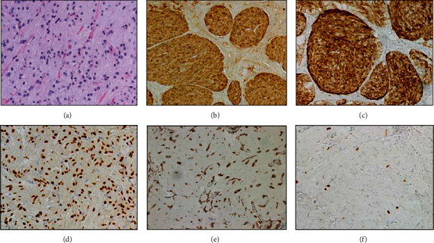 A Rare Case of Multifocal Asynchronous Benign Granular Cell Tumors with <i>PIK3CA</i> Subclonal Mutation Identified in One Tumor by Next-Generation Sequencing.