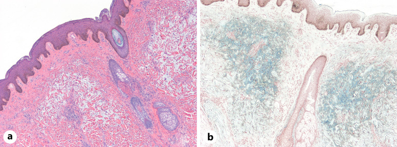 Reticular Erythematous Mucinosis in an African Woman with HIV Infection: Case Report and Literature Review.