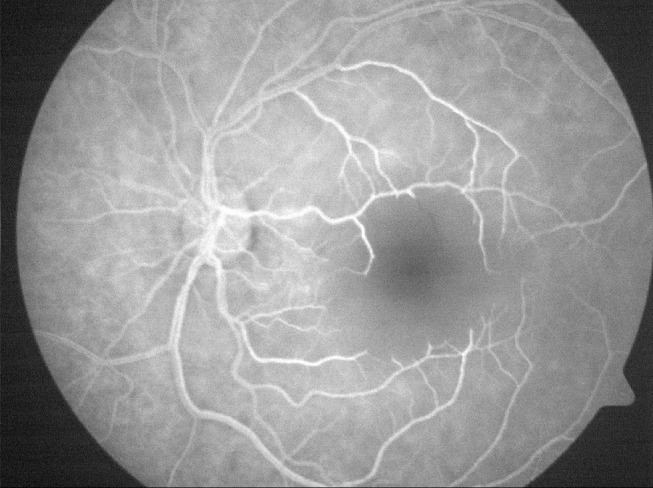 Neuroprotection for Nonarteritic Central Retinal Artery Occlusion: Lessons from Acute Ischemic Stroke.