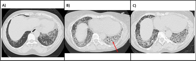 Post COVID Interstitial Lung Abnormalities-Incidence and Management.