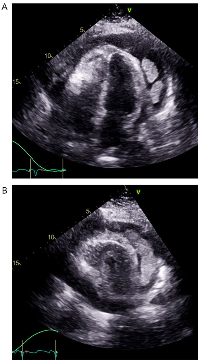 A Case of Pericarditis and Pericardial Masses Associated With Mycobacterium Paragordonae.