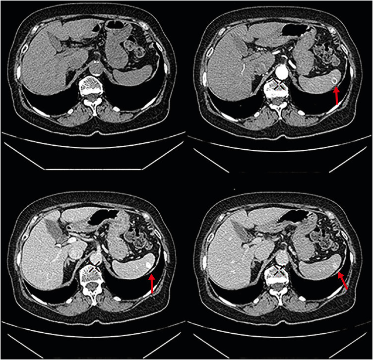 Persistent Fever in a Patient With Mechanical Mitral Valve Replacement.