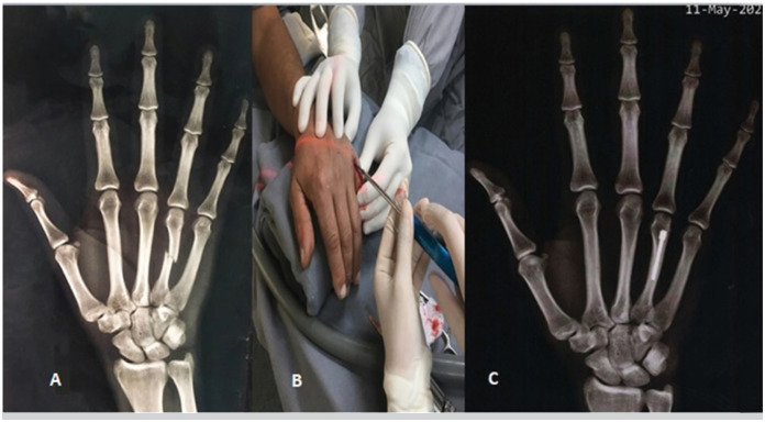 METACARPAL FRACTURES TREATMENT: COMPARASION BETWEEN KIRSCHNER WIRE AND INTRAMEDULLARY SCREW.