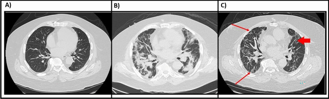 Post COVID Interstitial Lung Abnormalities-Incidence and Management.