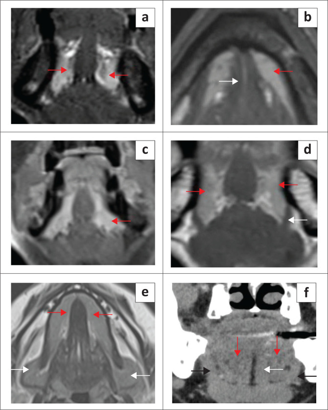 Imaging evaluation of the benign and malignant lesions of the floor of the mouth: Pictorial review.