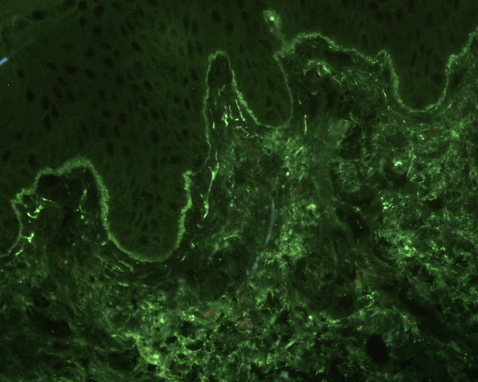 Reticular Erythematous Mucinosis in an African Woman with HIV Infection: Case Report and Literature Review.